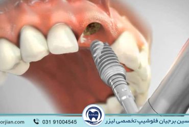 نقش متخصص ایمپلنت در میزان موفقیت کاشت دندان | بهترین ایمپلنت اصفهان