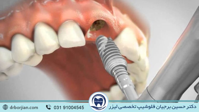 نقش متخصص ایمپلنت در میزان موفقیت کاشت دندان | بهترین ایمپلنت اصفهان