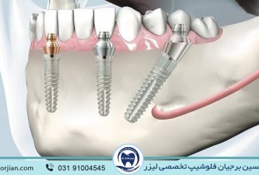 امکان کاشت یکباره چند ایمپلنت دندان | ایمپلنت دندان سوئیسی در اصفهان