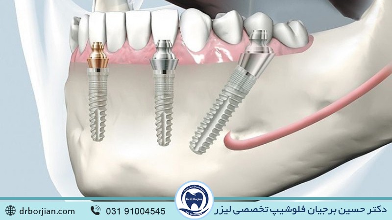 بهترین ایمپلنت اصفهان | ایمپلنت دندان سوئیسی در اصفهان | امکان کاشت یکباره چند ایمپلنت دندان | ایمپلنت دندان سوئیسی در اصفهان