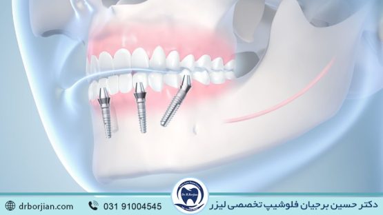 بهترین ایمپلنت اصفهان | ایمپلنت دندان سوئیسی در اصفهان | سن مناسب برای کاشت ایمپلنت دندان | بهترین ایمپلنت اصفهان