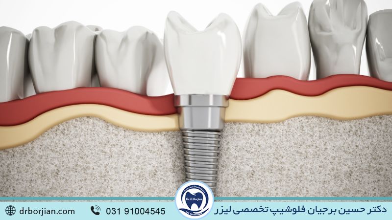 عوامل موثر در طول عمر ایمپلنت دندان | بهترین ایمپلنت اصفهان