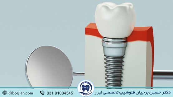مزیت کاشت ایمپلنت دندان توسط بهترین متخصص اصفهان | بهترین ایمپلنت اصفهان