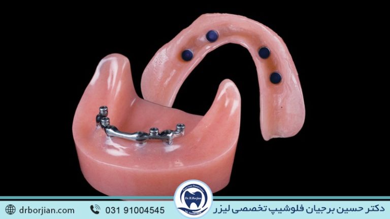 مقایسه اوردنچر با ایمپلنت دندان | بهترین ایمپلنت اصفهان