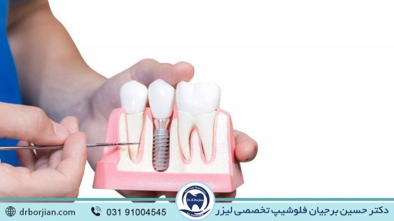 بهترین ایمپلنت اصفهان | ایمپلنت دندان سوئیسی در اصفهان | موارد موثر در استحکام ایمپلنت دندان | بهترین ایمپلنت اصفهان