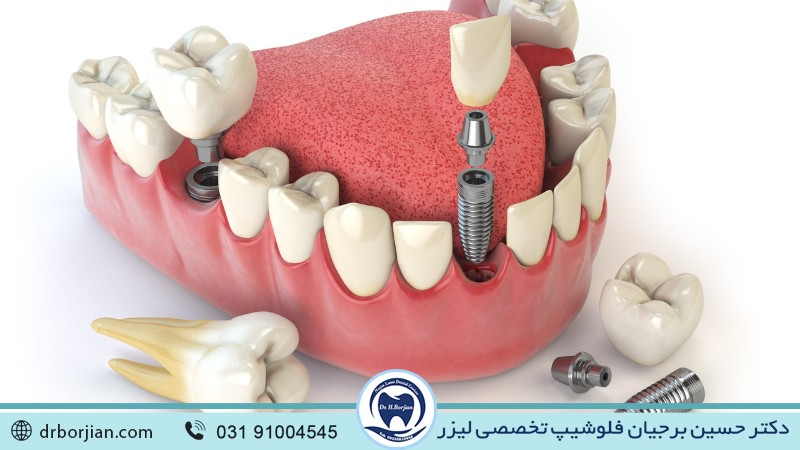 موارد نیاز به ایمپلنت دندان لترال | بهترین ایمپلنت اصفهان