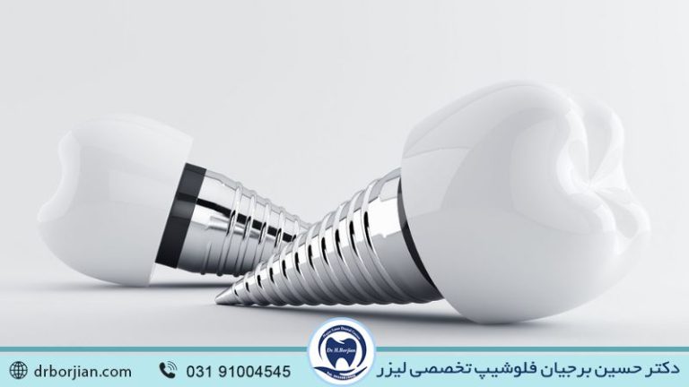 هزینه کاشت دندان در اصفهان | بهترین ایمپلنت اصفهان | ایمپلنت دندان سوئیسی در اصفهان