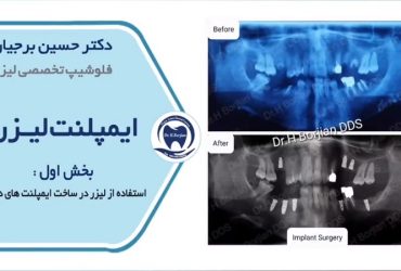 استفاده از لیزر درساخت ایمپلنت های دندان | بهترین ایمپلنت اصفهان