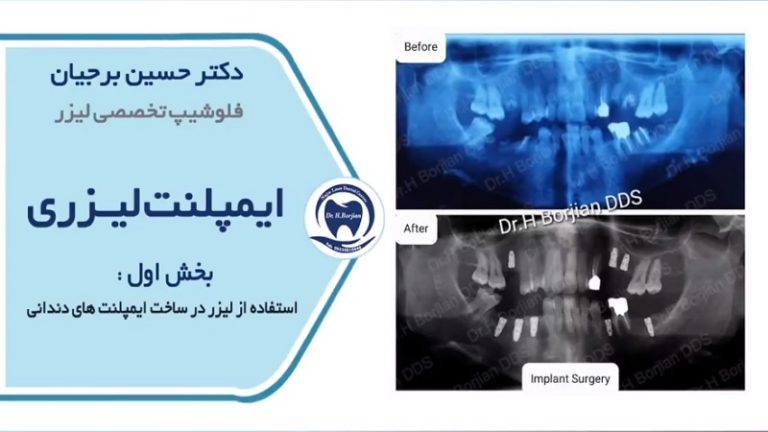 استفاده از لیزر درساخت ایمپلنت های دندان | بهترین ایمپلنت اصفهان