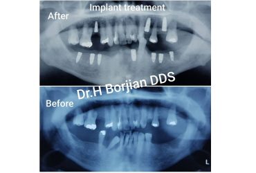 درمان ایمپلنت های دندانی | بهترین ایمپلنت اصفهان