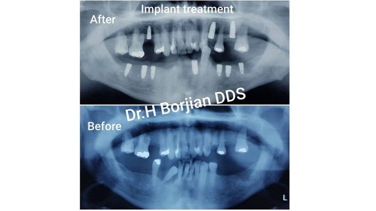 درمان ایمپلنت های دندانی | بهترین ایمپلنت اصفهان
