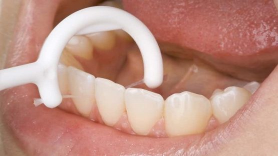 بهترین ایمپلنت اصفهان | ایمپلنت دندان سوئیسی در اصفهان | نکاتی در مورد نخ دندان کشیدن با ایمپلنت‌