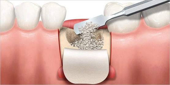 پیوند استخوان دندان چگونه کار می‌کند؟ | بهترین ایمپلنت اصفهان
ایمپلنت دندان سوئیسی در اصفهان