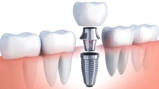 بهترین ایمپلنت اصفهان | ایمپلنت دندان سوئیسی در اصفهان | ایمپلنت فوری