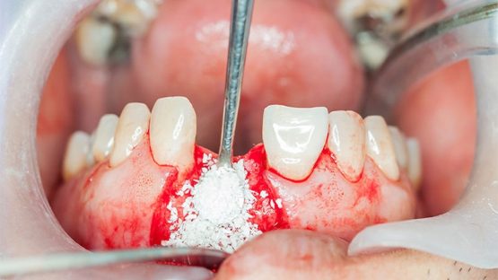 پیوند استخوان دندان چیست؟ | بهترین ایمپلنت اصفهان
ایمپلنت دندان سوئیسی در اصفهان