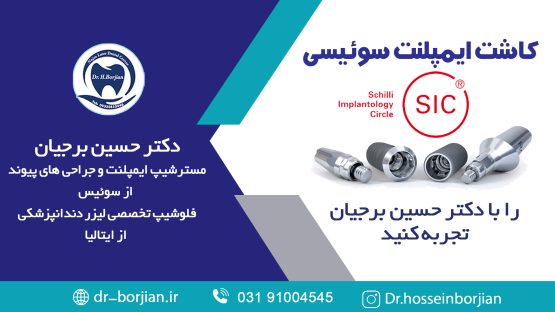 بهترین ایمپلنت اصفهان | ایمپلنت دندان سوئیسی در اصفهان | کلیپ آپارات کاشت ایمپلنت سوئیسی SIC با دکتر حسین برجیان|متخصص ایمپلنت اصفهان