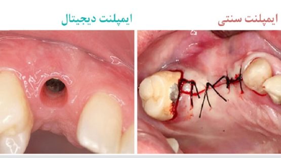 مزایا و معایب ایمپلنت دیجیتال دندان | بهترین ایمپلنت اصفهان
ایمپلنت دندان سوئیسی در اصفهان