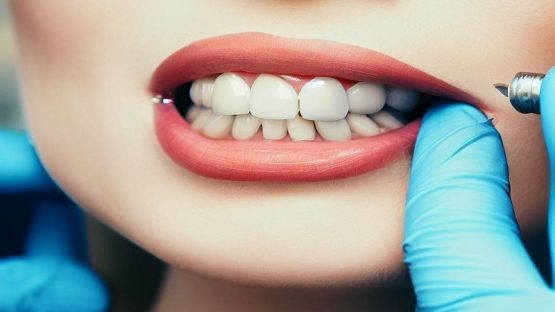 بهترین ایمپلنت اصفهان | ایمپلنت دندان سوئیسی در اصفهان | مدت زمان کاشت ایمپلنت دندان