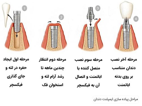 بهترین ایمپلنت اصفهان | ایمپلنت دندان سوئیسی در اصفهان | مراحل اولیه درمان ایمپلنت دندان