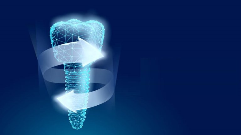 بهترین ایمپلنت اصفهان | ایمپلنت دندان سوئیسی در اصفهان | ضرورت کاشت ایمپلنت دندان