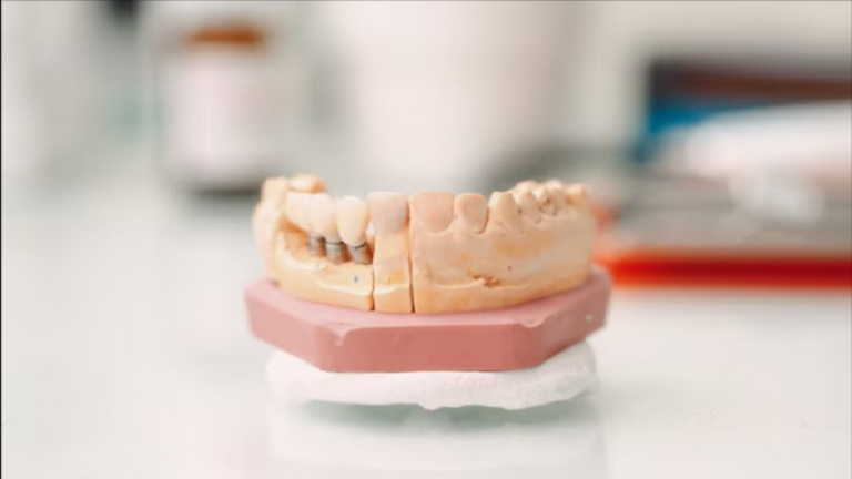 بهترین ایمپلنت اصفهان | ایمپلنت دندان سوئیسی در اصفهان | قالب گیری ایمپلنت مرحله ای حساس در کاشت دندان