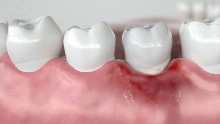 بهترین ایمپلنت اصفهان | ایمپلنت دندان سوئیسی در اصفهان | درمان پری ایمپلنتایتیس