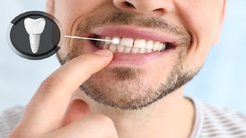 بهترین ایمپلنت اصفهان | ایمپلنت دندان سوئیسی در اصفهان | چرا عارضه عفونت ایمپلنت دندان رخ می دهد ؟
