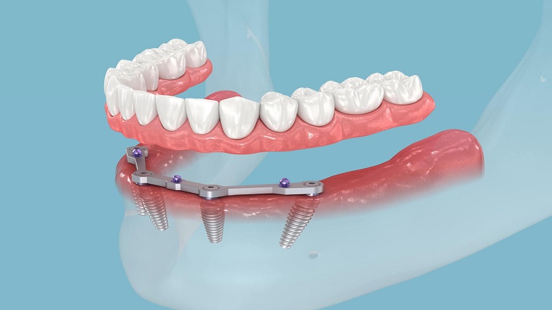بهترین ایمپلنت اصفهان | ایمپلنت دندان سوئیسی در اصفهان | All-on-4+Implants