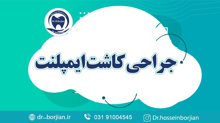 کلیپ آپارات جراحی کاشت ایمپلنت|متخصص ایمپلنت اصفهان