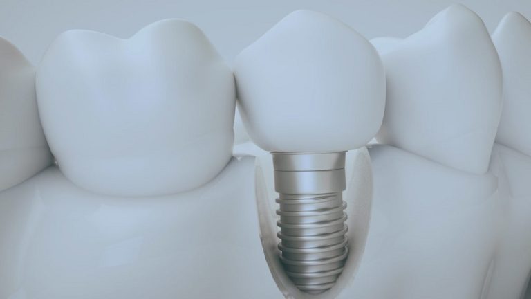 بهترین ایمپلنت اصفهان | ایمپلنت دندان سوئیسی در اصفهان | عوارض شایع ایمپلنت دندان از زبان متخصص ایمپلنت اصفهان