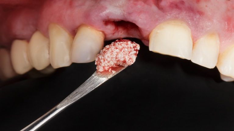 بهترین ایمپلنت اصفهان | ایمپلنت دندان سوئیسی در اصفهان | هزینه پیوند استخوان برای ایمپلنت چقدر است ؟