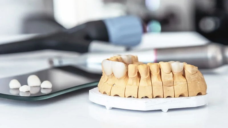 بهترین ایمپلنت اصفهان | ایمپلنت دندان سوئیسی در اصفهان | هزینه کاشت ایمپلنت در اصفهان