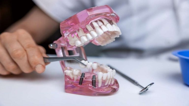 بهترین ایمپلنت اصفهان | ایمپلنت دندان سوئیسی در اصفهان | ۶ مورد از علائم پس زدن ایمپلنت بعد از جراحی کاشت دندان