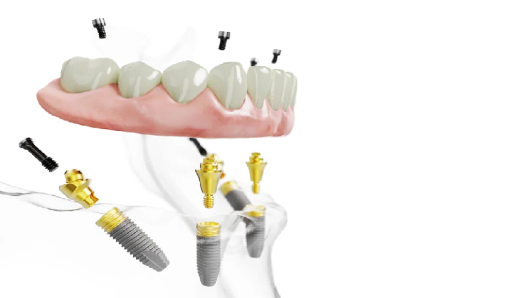 بهترین ایمپلنت اصفهان | ایمپلنت دندان سوئیسی در اصفهان | مراحل کاشت دندان به تکنیک all-on-۴
