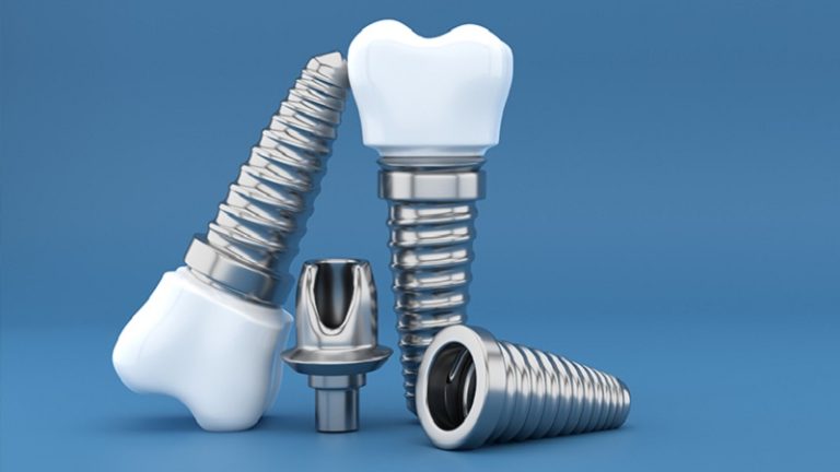 بهترین ایمپلنت اصفهان | ایمپلنت دندان سوئیسی در اصفهان | قیمت ایمپلنت اصفهان | برند ایمپلنت دندان