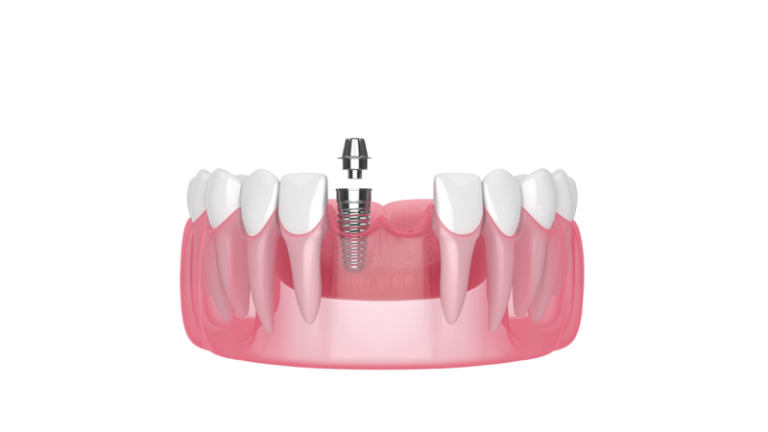 بهترین ایمپلنت اصفهان | ایمپلنت دندان سوئیسی در اصفهان | قیمت ایمپلنت اصفهان |مزایای کاشت مینی ایمپلنت دندان 