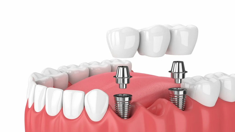 بهترین ایمپلنت اصفهان | ایمپلنت دندان سوئیسی در اصفهان | قیمت ایمپلنت اصفهان | ایمپلنت دندان فاصله دار و نکاتی پیرامون آن