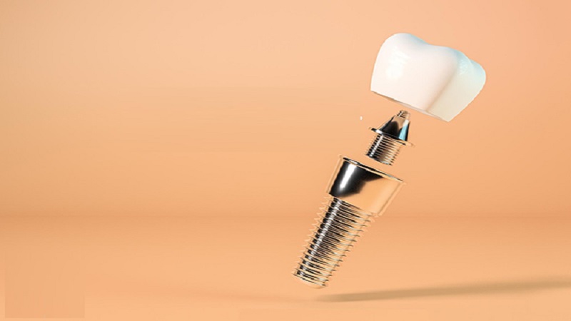 بهترین ایمپلنت اصفهان | ایمپلنت دندان سوئیسی در اصفهان | 11 دلیل افتادن روکش ایمپلنت دندان