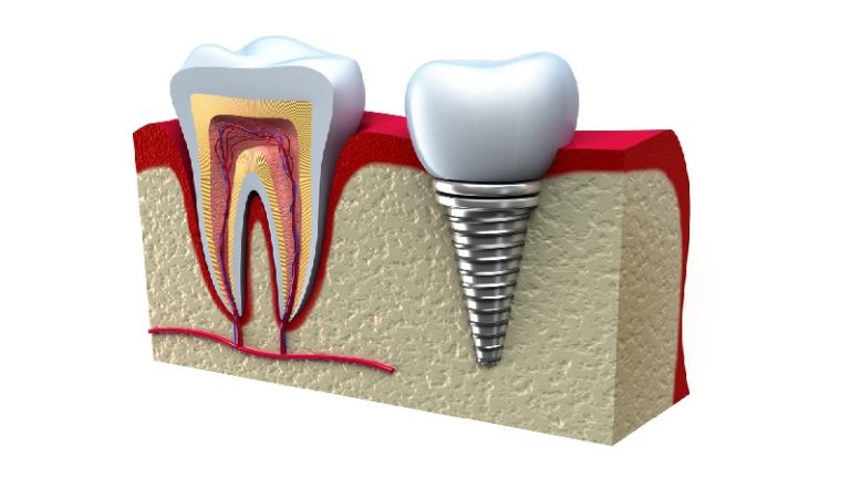 بهترین ایمپلنت اصفهان | ایمپلنت دندان سوئیسی در اصفهان | قیمت ایمپلنت اصفهان |17 دلیل برای لق شدن ایمپلنت دندان