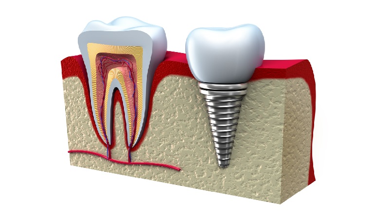 بهترین ایمپلنت اصفهان | ایمپلنت دندان سوئیسی در اصفهان | قیمت ایمپلنت اصفهان |17 دلیل برای لق شدن ایمپلنت دندان