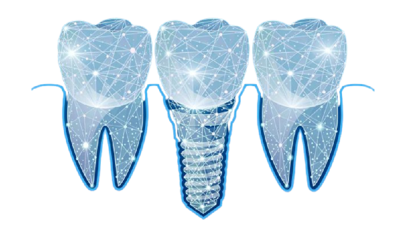 بهترین ایمپلنت اصفهان | ایمپلنت دندان سوئیسی در اصفهان | 13 تفاوت ایمپلنت دیجیتال با ایمپلنت دندان معمولی