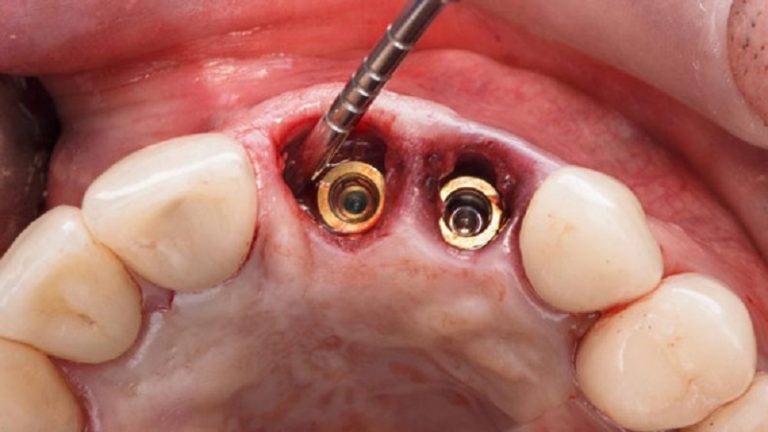 بهترین ایمپلنت اصفهان | ایمپلنت دندان سوئیسی در اصفهان | قیمت ایمپلنت اصفهان |ایمپلنت برای افرادی که اعتیاد دارند چطور است ؟