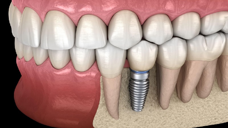 بهترین ایمپلنت اصفهان | ایمپلنت دندان سوئیسی در اصفهان | قیمت ایمپلنت اصفهان | ایمپلنت دندان نیش نهفته