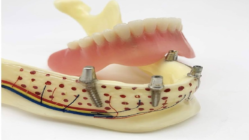 بهترین ایمپلنت اصفهان | ایمپلنت دندان سوئیسی در اصفهان | خصوصیات لازم استخوان فک برای کاشت ایمپلنت دندان 