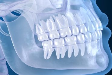عکس CBCT دندان برای ایمپلنت دندان