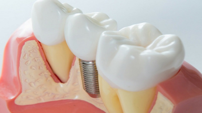 بهترین ایمپلنت اصفهان | ایمپلنت دندان سوئیسی در اصفهان | پس زدن ایمپلنت فوری