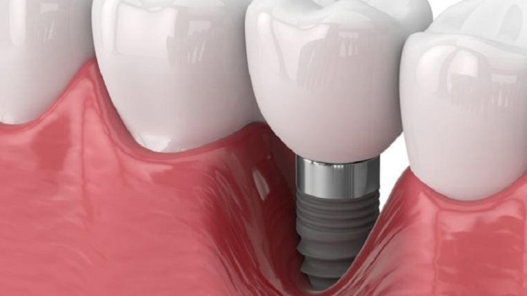 بهترین ایمپلنت اصفهان | ایمپلنت دندان سوئیسی در اصفهان | قیمت ایمپلنت اصفهان | چه عواملی باعث پوسیدگی و خرابی ایمپلنت می‌ شوند؟