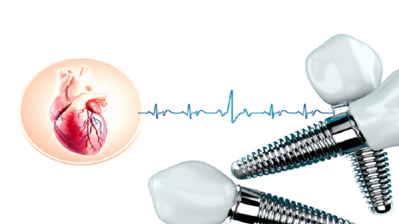 بهترین ایمپلنت اصفهان | ایمپلنت دندان سوئیسی در اصفهان | قیمت ایمپلنت اصفهان | 7 پیامد کاشت ایمپلنت دندان برای بیماران قلبی 