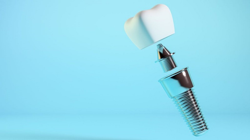 بهترین ایمپلنت اصفهان | ایمپلنت دندان سوئیسی در اصفهان | قیمت ایمپلنت اصفهان | عوامل موثر در مدتزمان ماندگاری ایمپلنت کدامند ؟