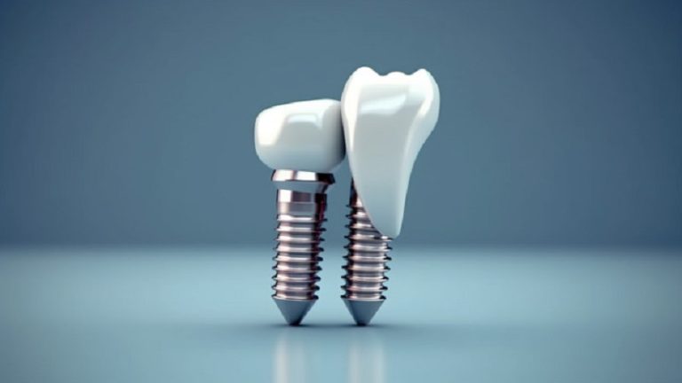 بهترین ایمپلنت اصفهان | ایمپلنت دندان سوئیسی در اصفهان | قیمت ایمپلنت اصفهان | تبلیغات ایمپلنت فوری